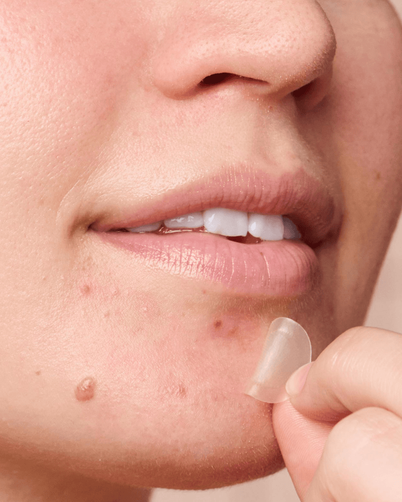 Might Patch - Micropoint for Blemishes